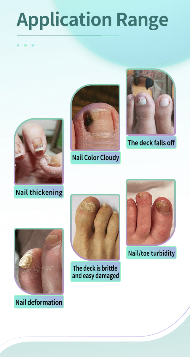 Advanced Light Therapy Device for Clearer, Healthier - Looking Nails - GroundedKiwi.nz fungushealthlaser